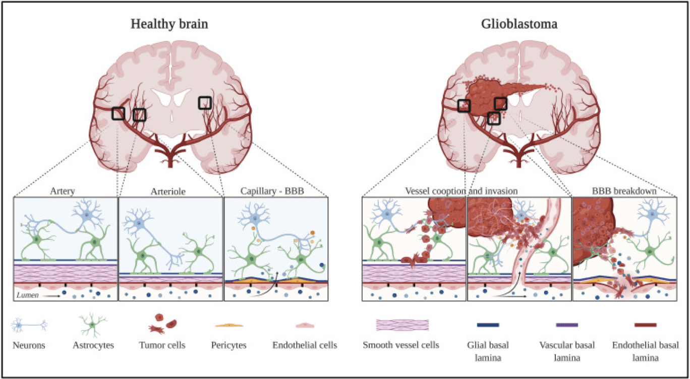 Structure of Glioblastoma and details on how the cancer affects neighbouring cells.